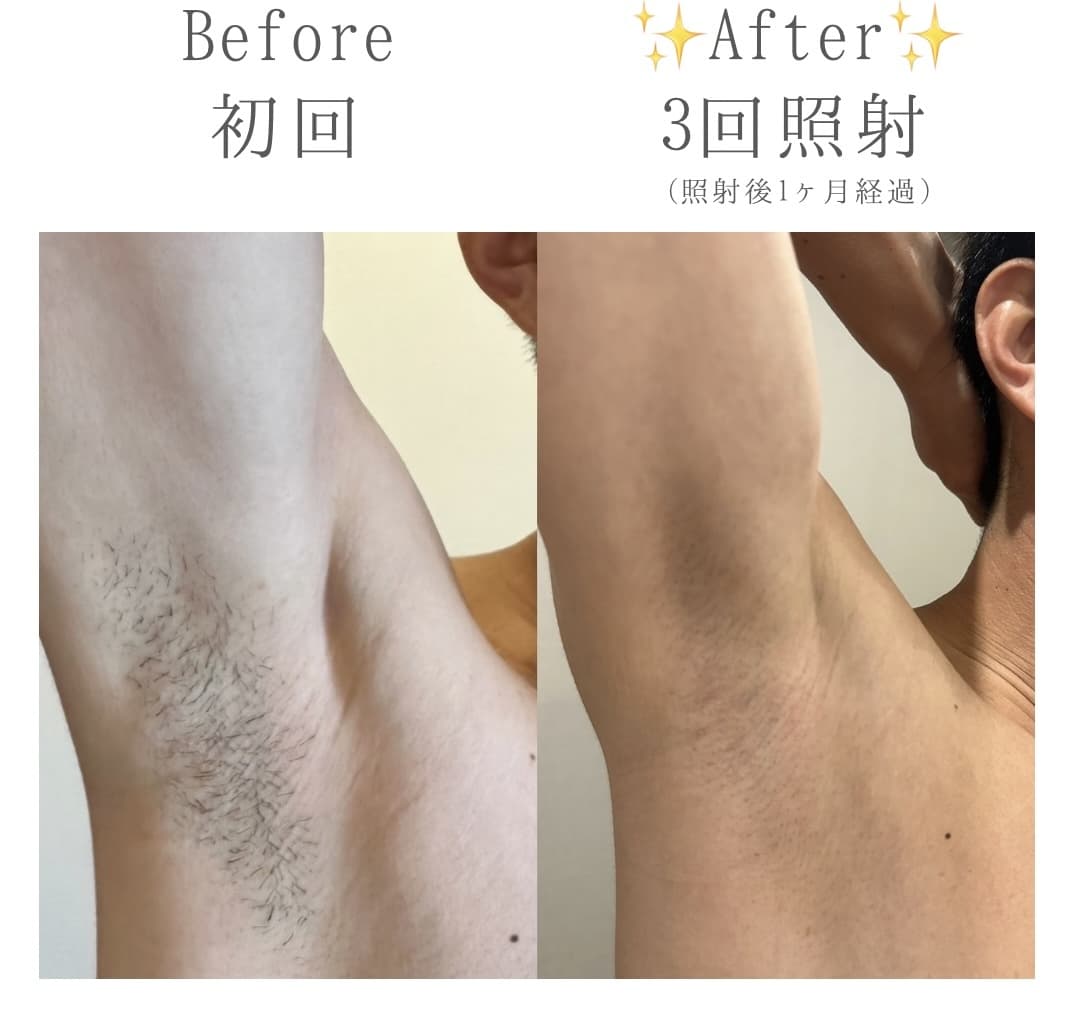 【メンズ】Before/After ワキ脱毛