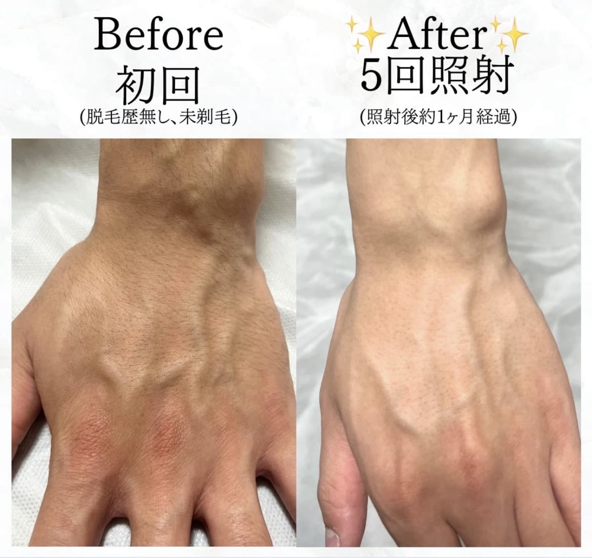 【メンズ】Before/After 手の甲脱毛