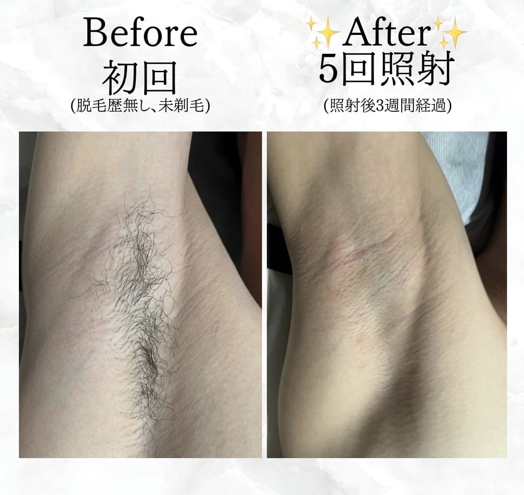 【メンズ】Before/After 脇・ワキ脱毛