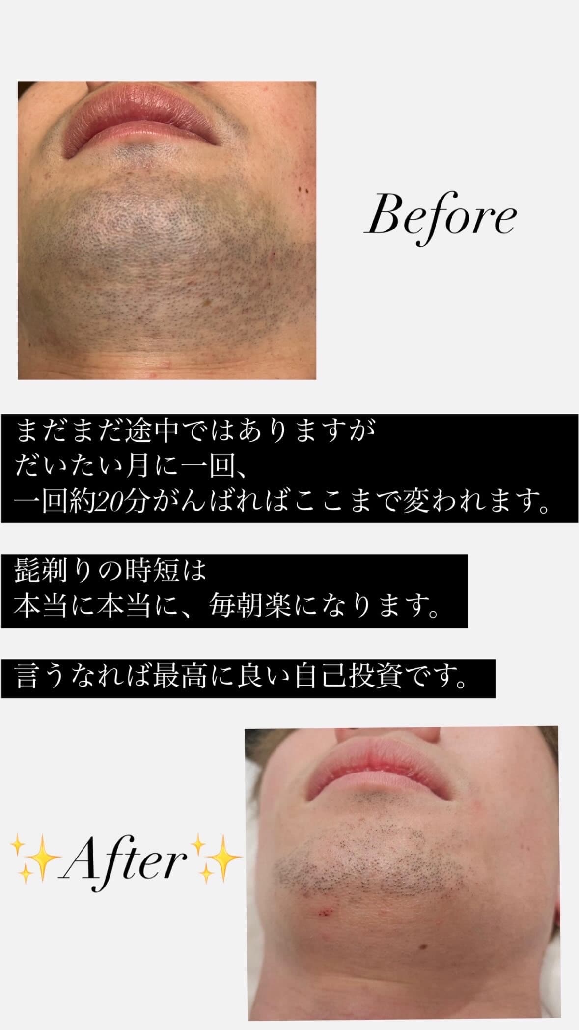 【最高の自己投資】ヒゲ脱毛で毎朝が楽になります!